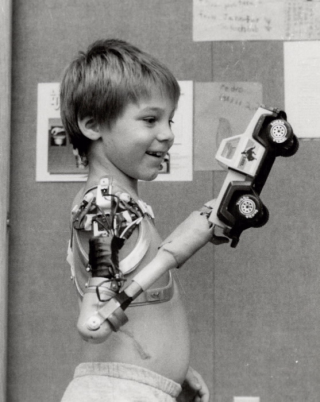 Photograph of boy, Scott Connor, smiling and holding a toy truck with his prosthetic arm Photograph of boy, Scott Connor, smiling and holding a toy truck with his prosthetic arm